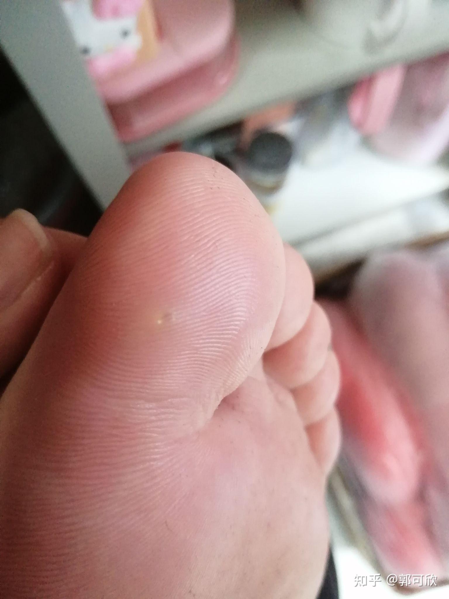 液氮冷冻鸡眼治疗贴