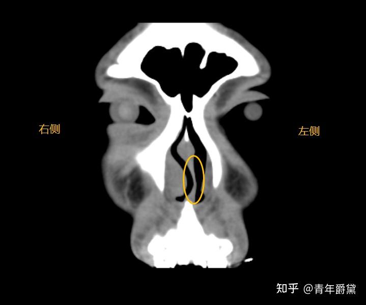 鼻中隔偏曲ct图片