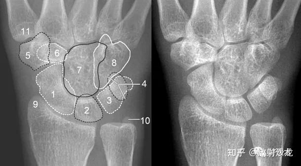 赞腕关节x线高清解剖腕骨脱位典型病例