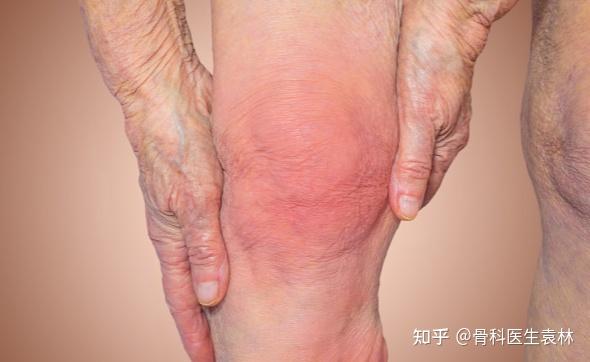 什么是膝关节骨关节炎天气一冷关节疼是怎么回事