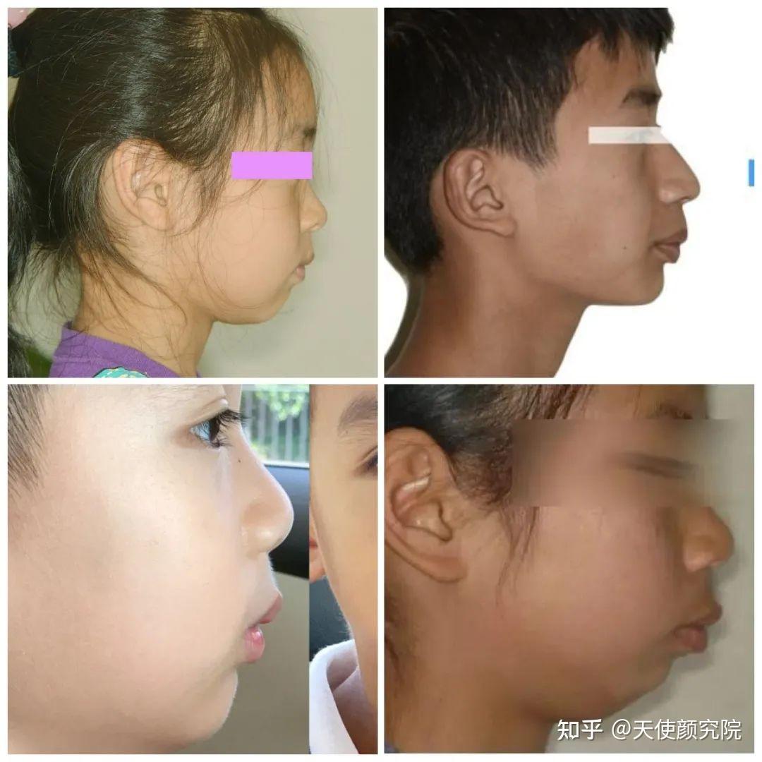 一,凸嘴发病率非常高,但未被重视