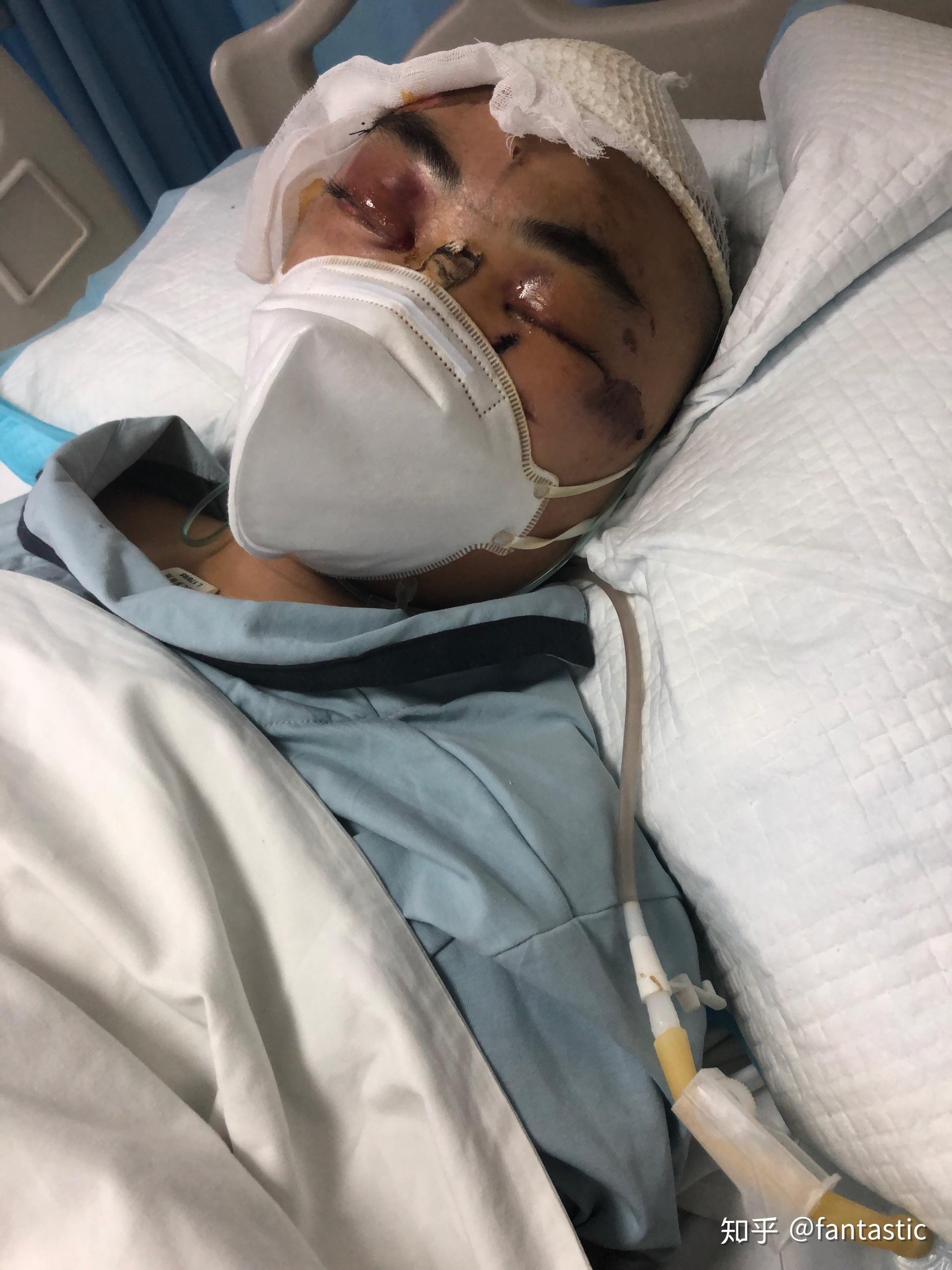 我弟弟才21岁患重型开放性颅脑外伤请大家救救他