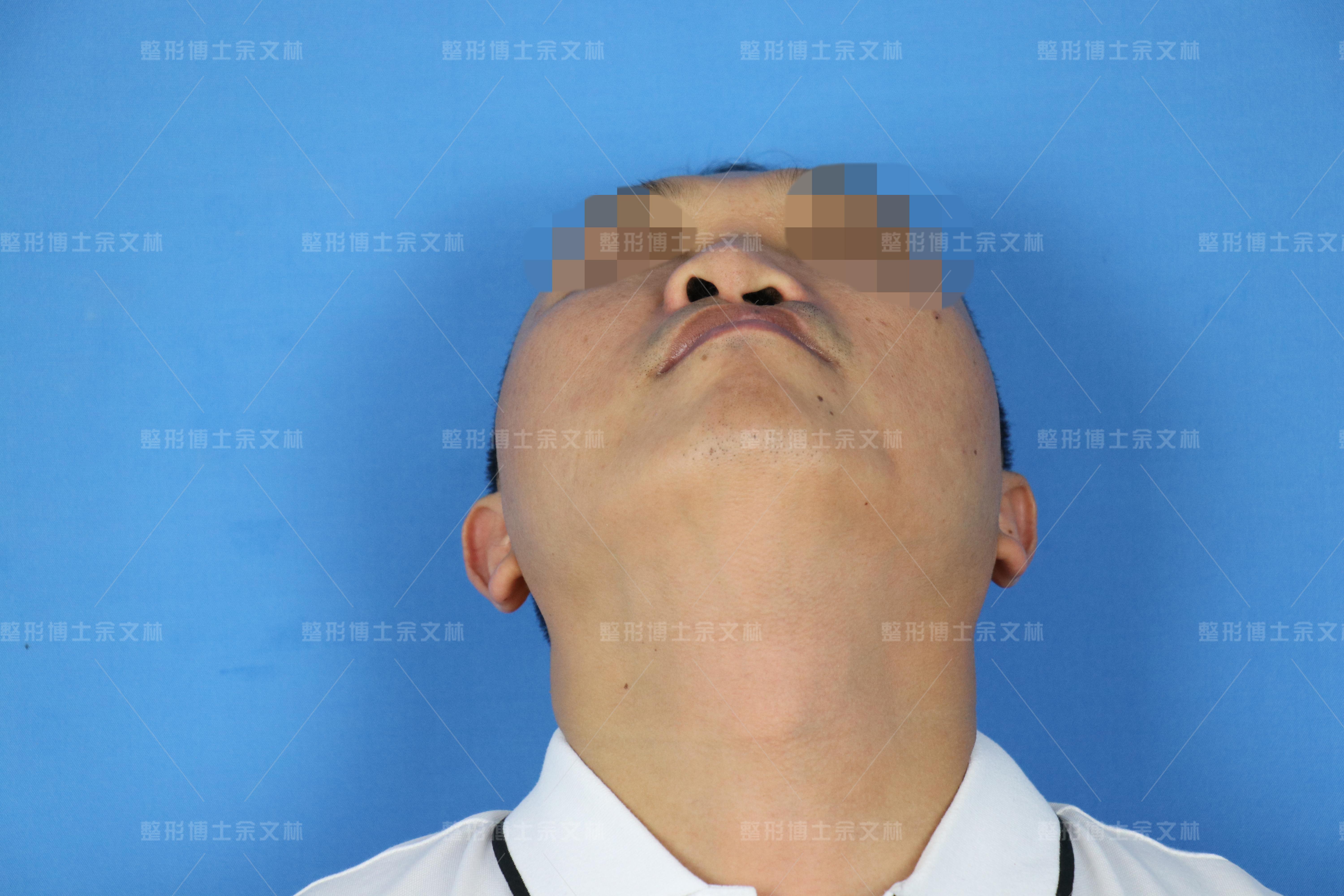 科普唇裂术后鼻小柱歪了什么时候矫正最好