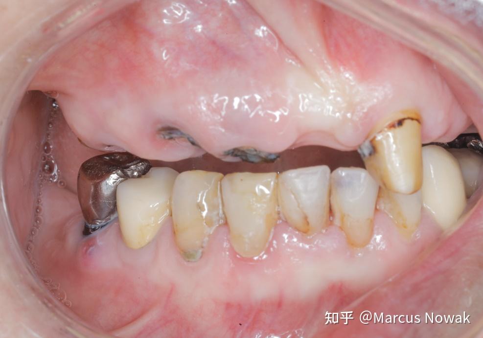 警惕你口中的不良假牙牙齿问题可能让你离癌症越来越近