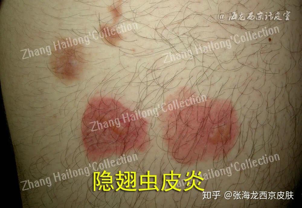 隐翅虫皮炎诊断标准是:3,诊断及鉴别诊断皮损多见于面部,颈部,四肢及