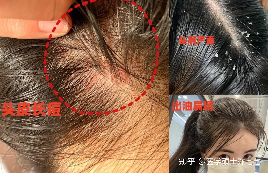 【全身除螨攻略】身上总是痒痒长痘,头皮也是,痘痘头屑没少过,脸也没逃过,每天洗脸还是油乎乎的!医学生从专业角度分析,这是螨虫在捣乱,教你全身 ...
