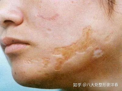 【瘢痕】为你揭开扩张器治疗瘢痕的神秘面纱!