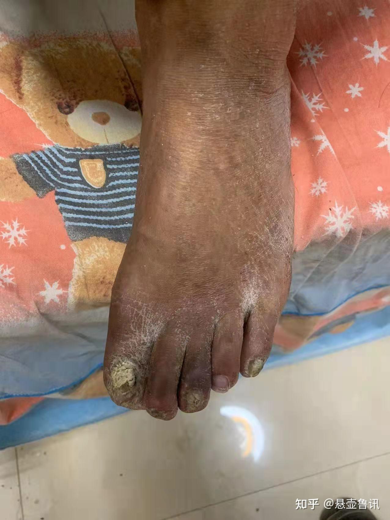 脉管炎杀不死人的活癌症