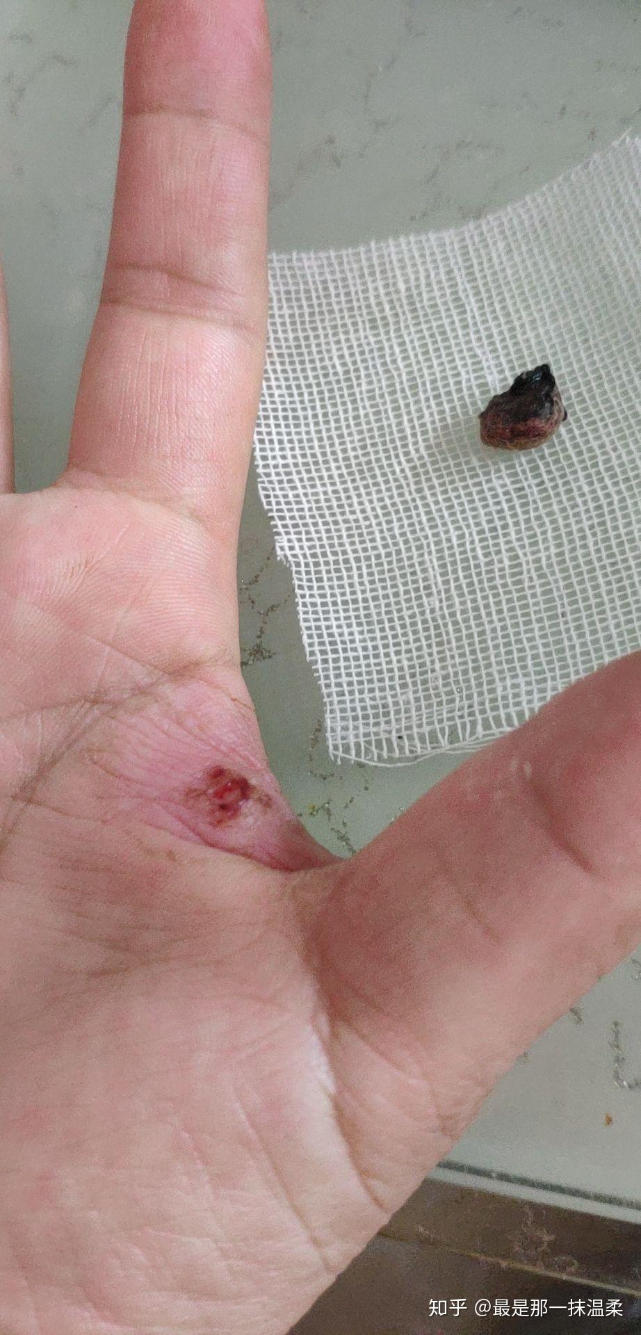 化脓性肉芽肿–后续 - 知乎