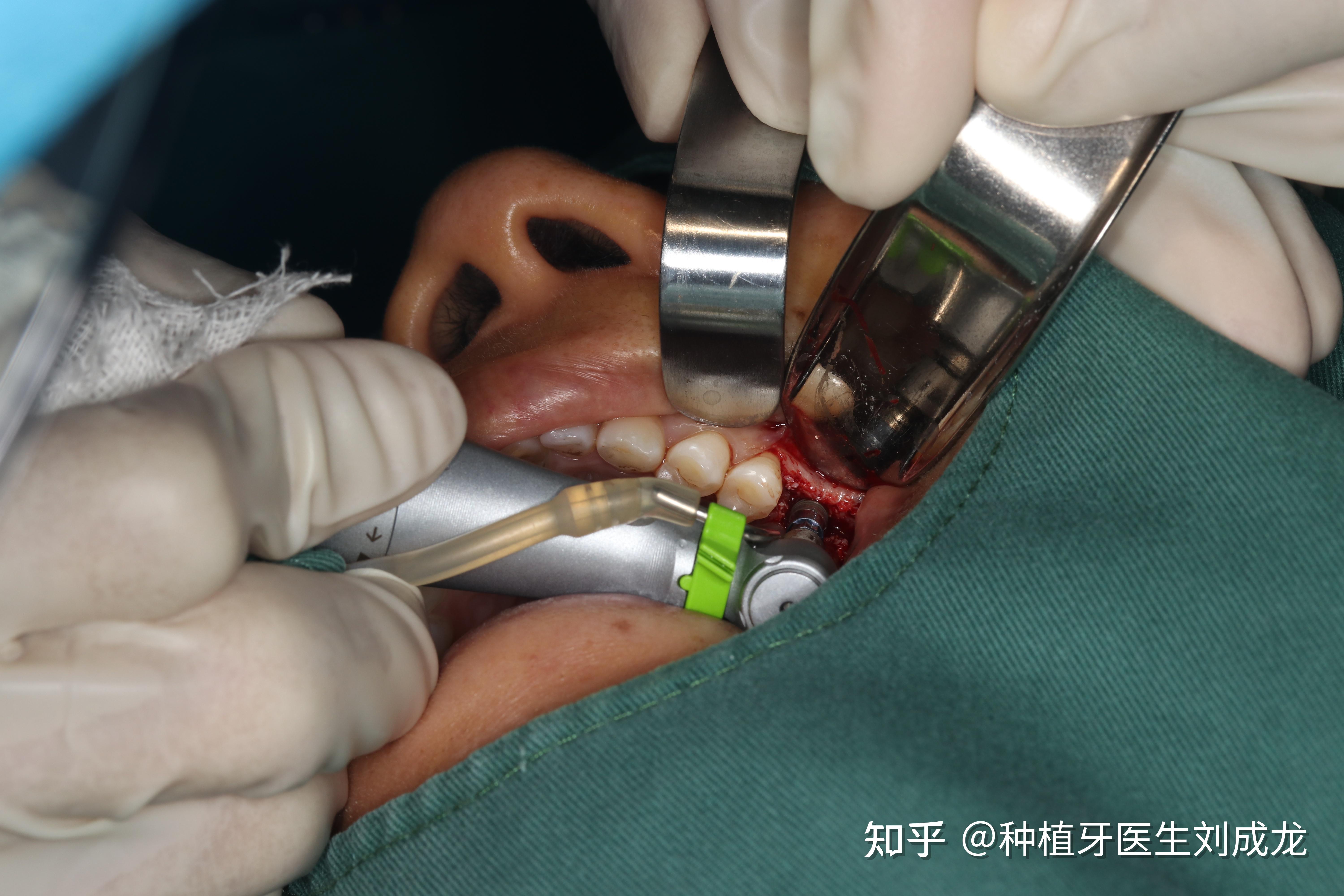 郑州种植牙上颌单颗瑞士iti亲水种植修复案例