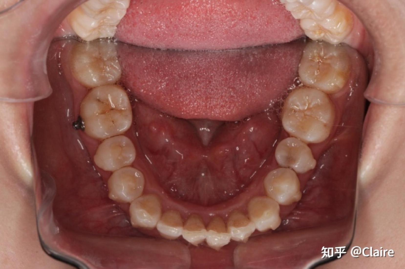 记录第一次蛀牙根管治疗的历程！（包括时间＋治疗费） - 知乎