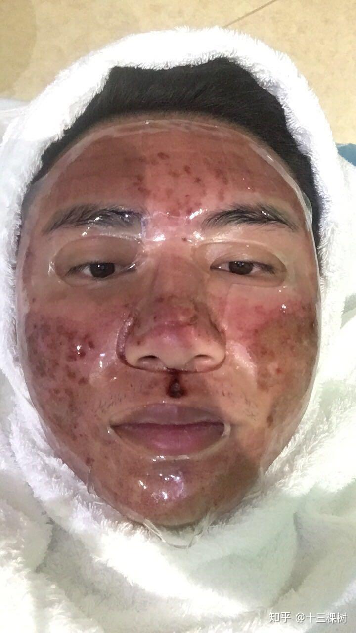 点阵激光结痂后社交怎么办