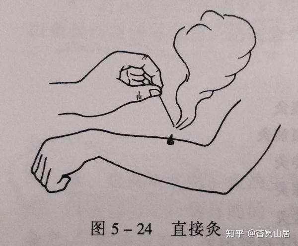 笔记摘要——针灸技术：毫针刺法、补泻原则与灸法概要 - 知乎