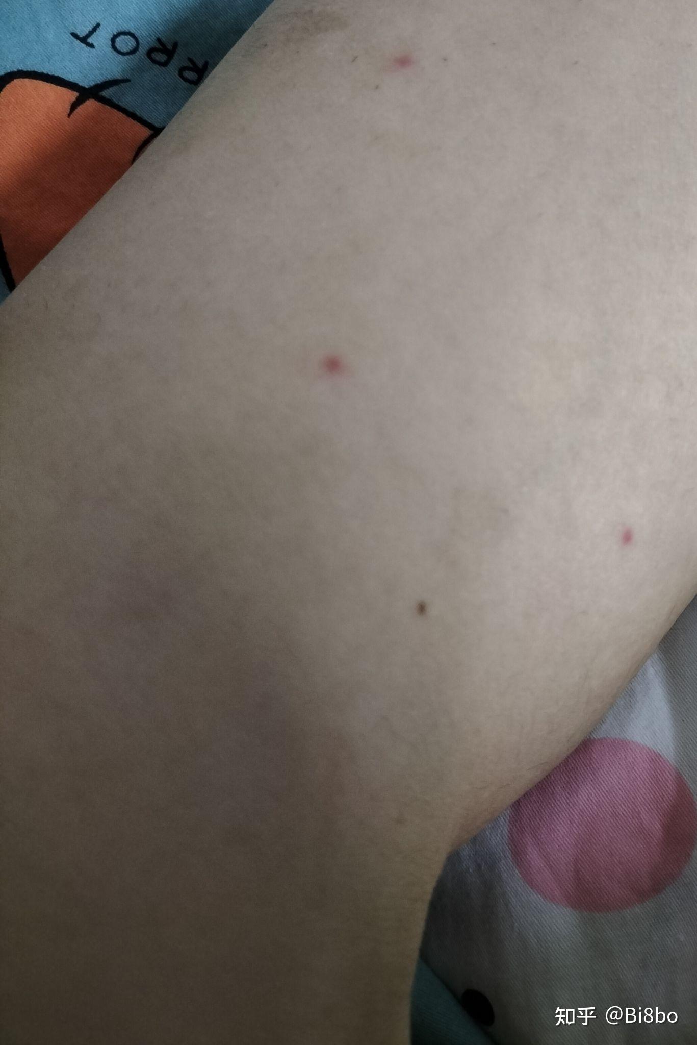 胳膊手腿长了小红点的原因是什么 - 知乎