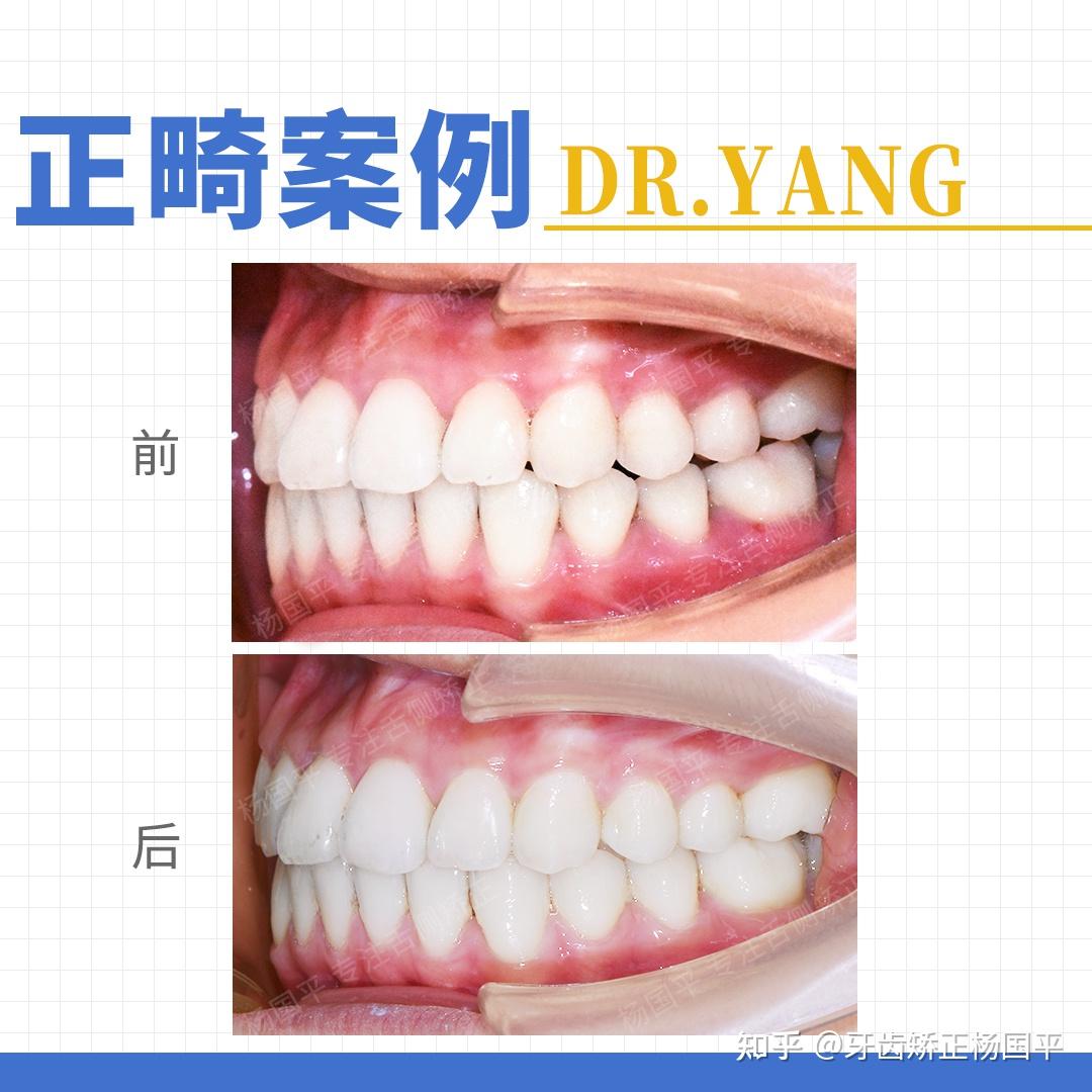 上海舌侧矫正|牙齿开颌详细-案例分享 - 知乎