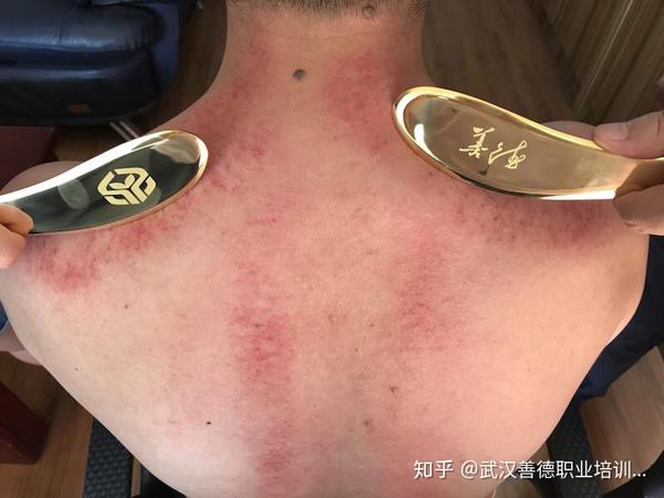 浅谈中医那些事刮痧