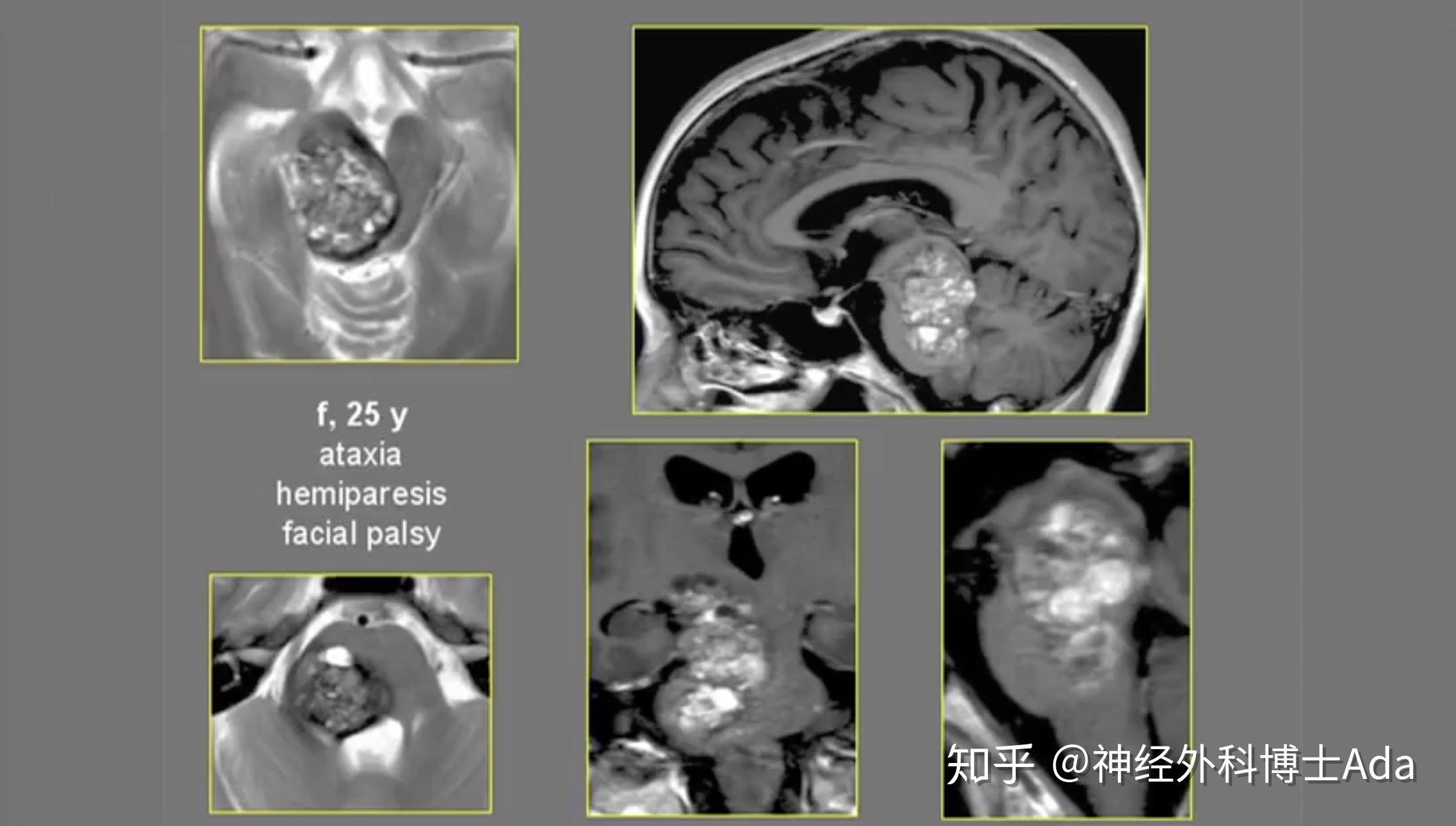 25岁女性巨大脑干海绵状血管瘤全切手术病例
