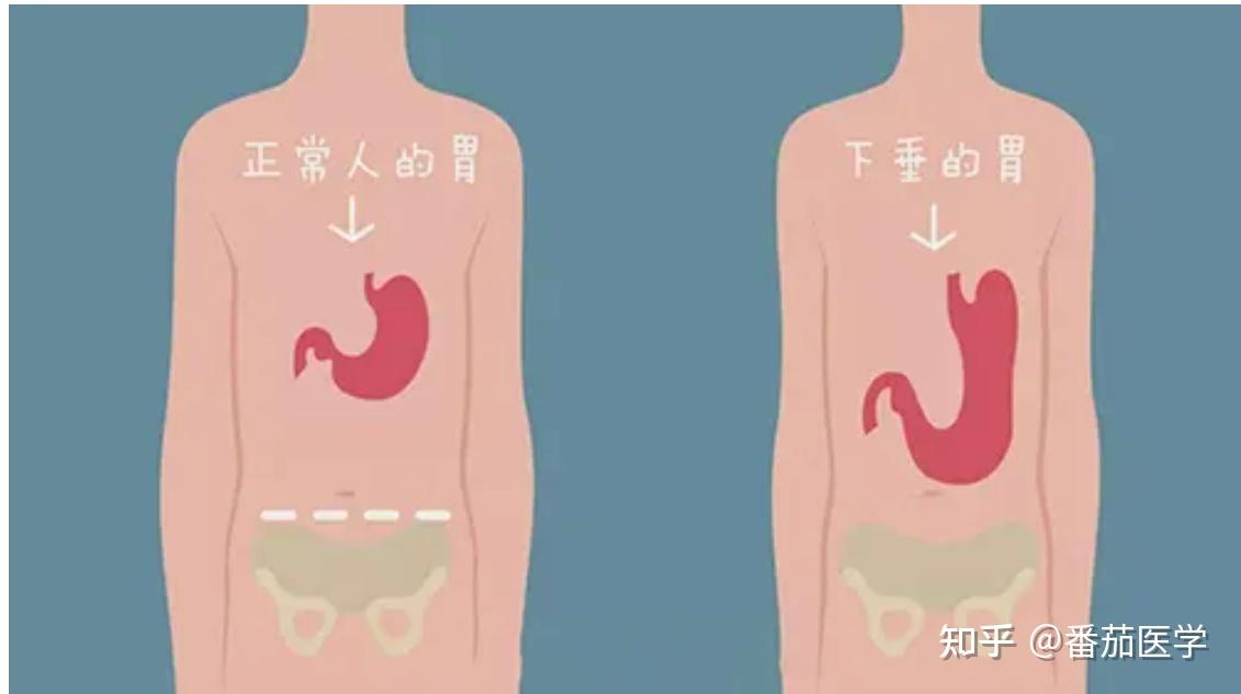 饭后运动会不会胃下垂