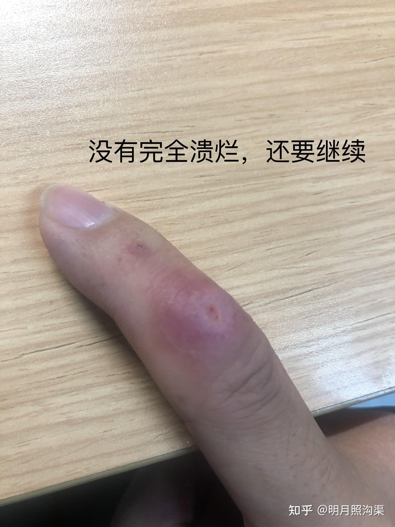 鸦胆子油治疗寻常疣(可能)