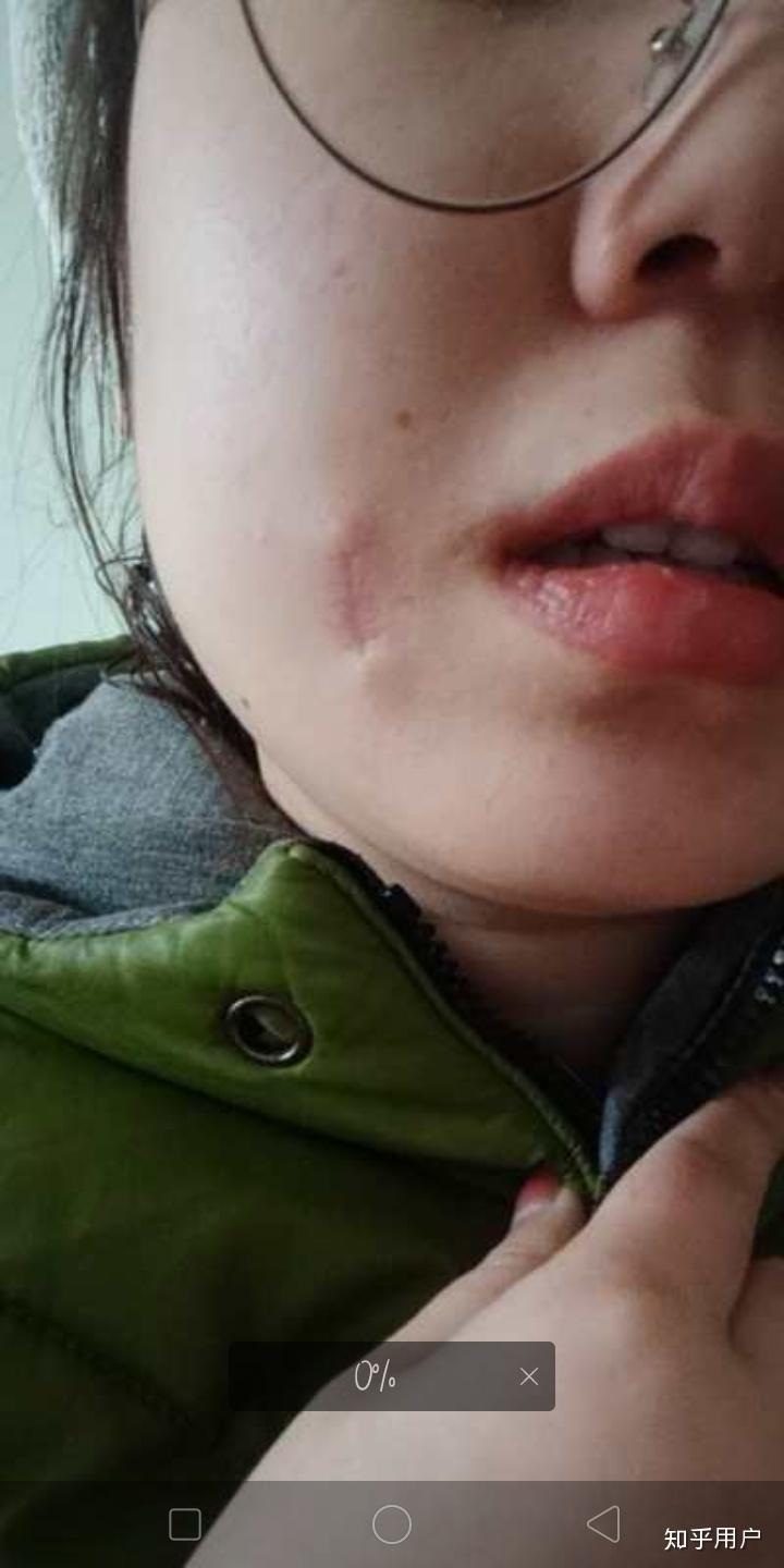 女生脸上有疤是怎样的体验? - 知乎