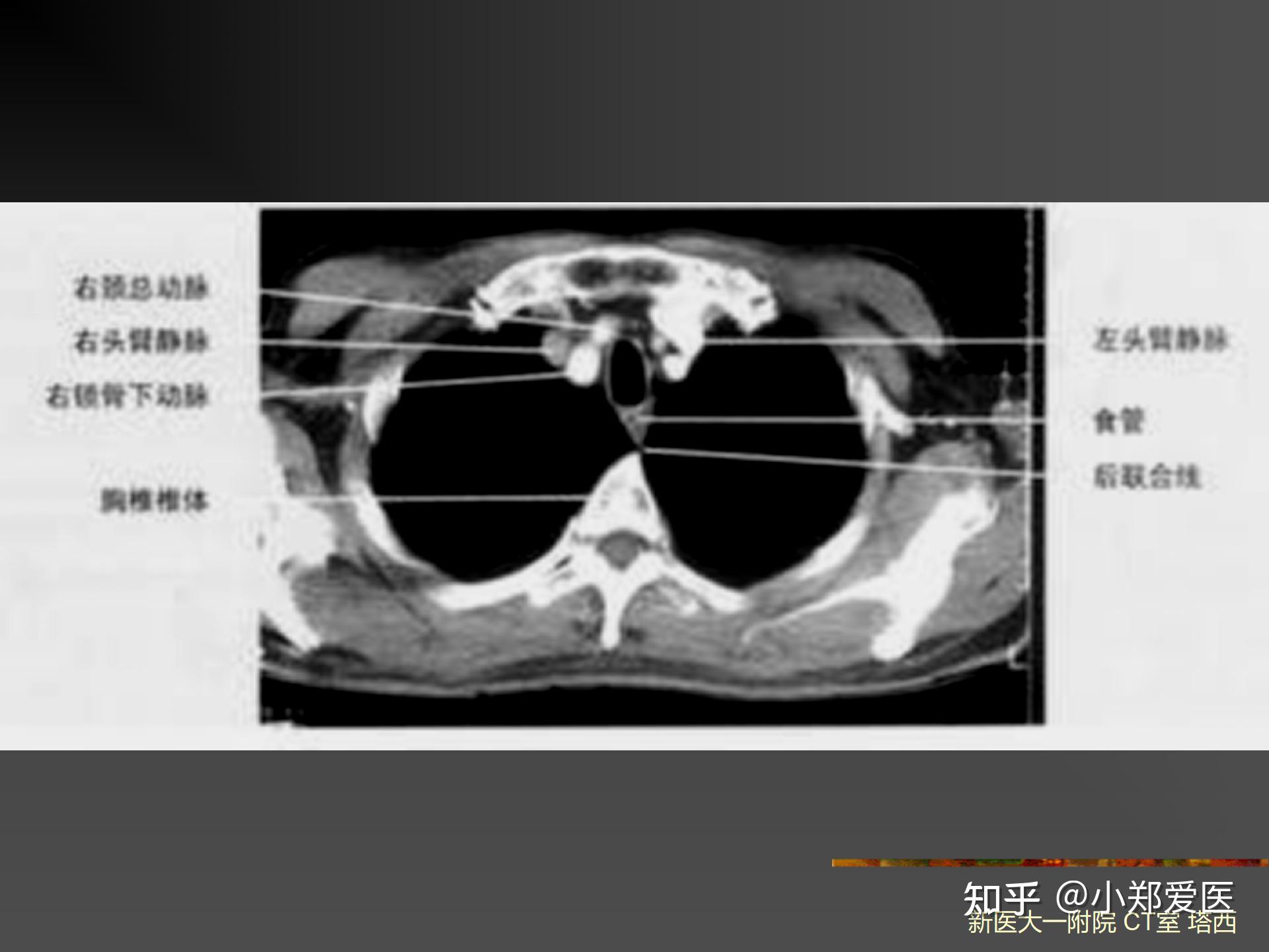 从0到1带你学会读ct片之呼吸系统影像学诊断（科普） 知乎 