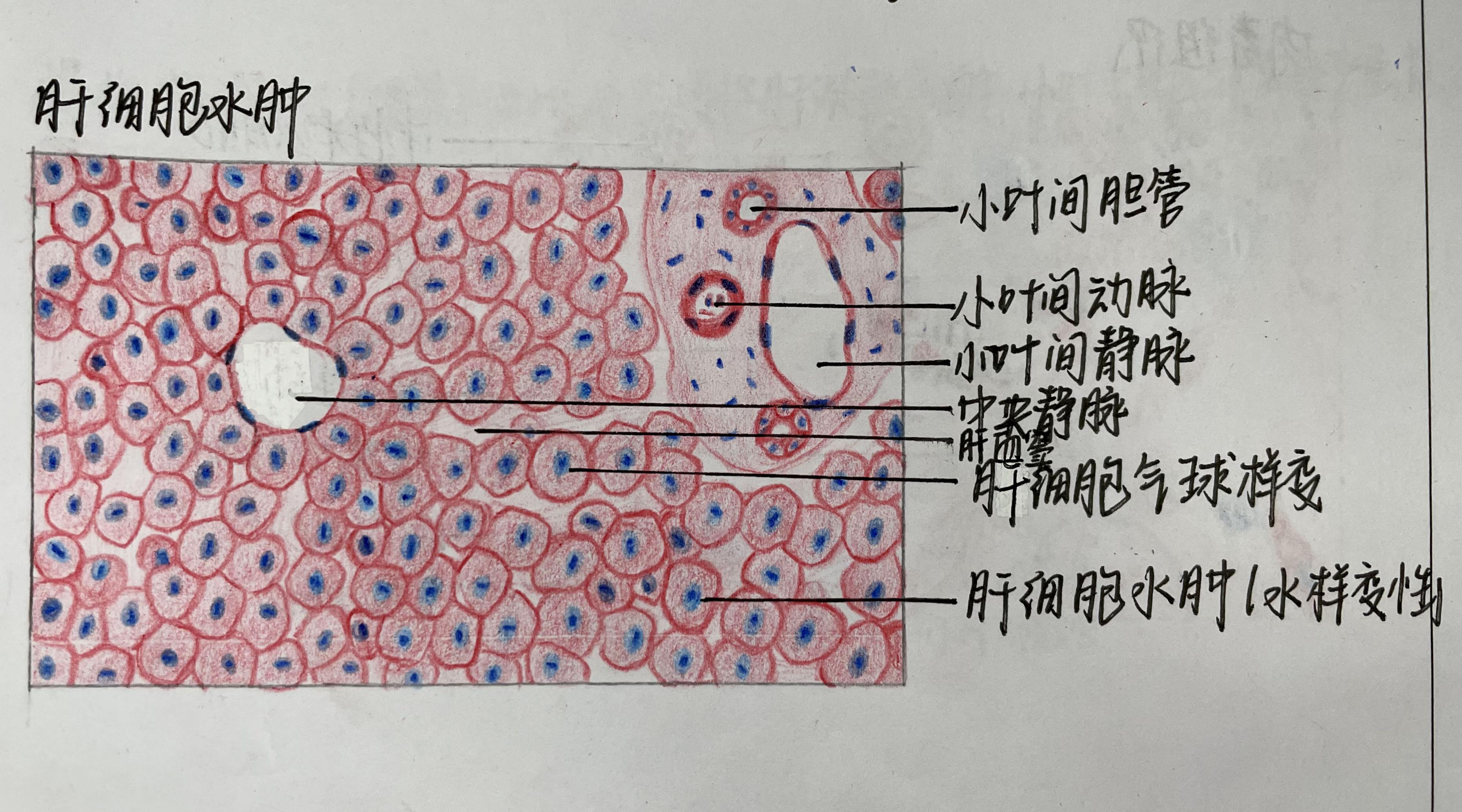 ②肝细胞明显肿胀,胞质疏松,可见淡红色颗粒样物,核偏位;①肝索增宽