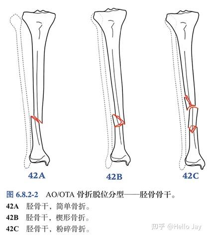 胫骨骨干骨折的治疗原则 知乎