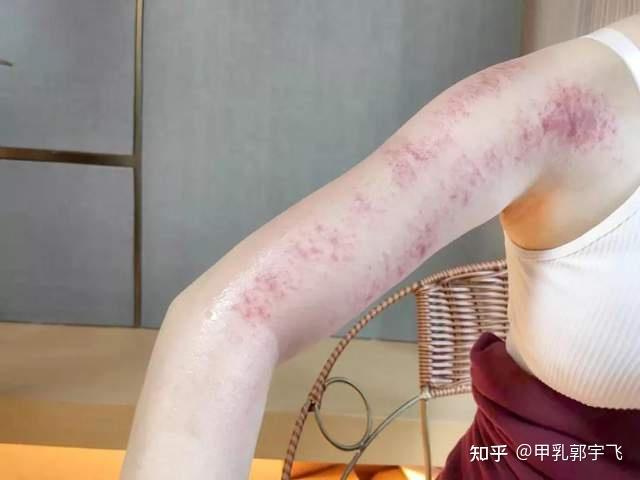 立春后用刮痧法散乳腺结节不伤身散结快