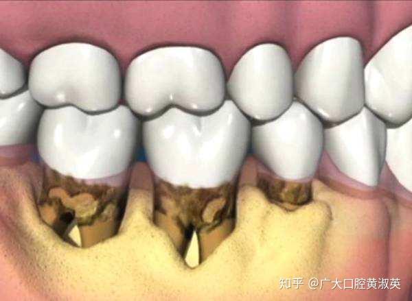 该死的牙菌斑有多恐怖
