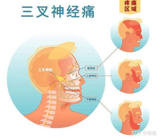 无痛介入治疗三叉神经痛原理及适应人群 - 知乎