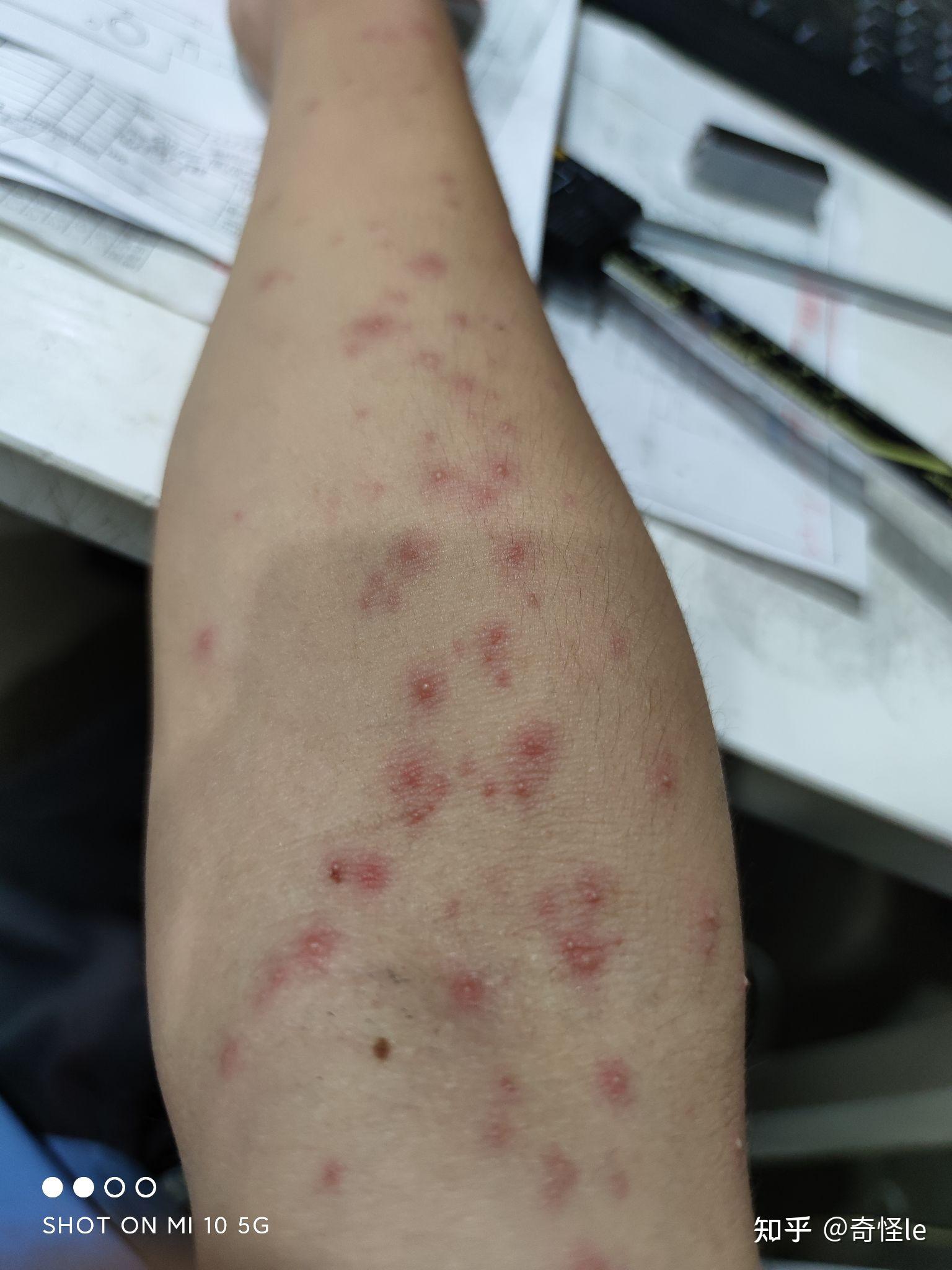 水痘还是hiv - 知乎