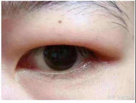 什么是双眼皮肌无力 v2-71f27d83a6b3de4fade29975b3103889_r.jpg
