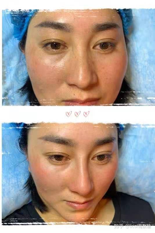 那葡聚糖隆鼻真的靠谱吗?3.