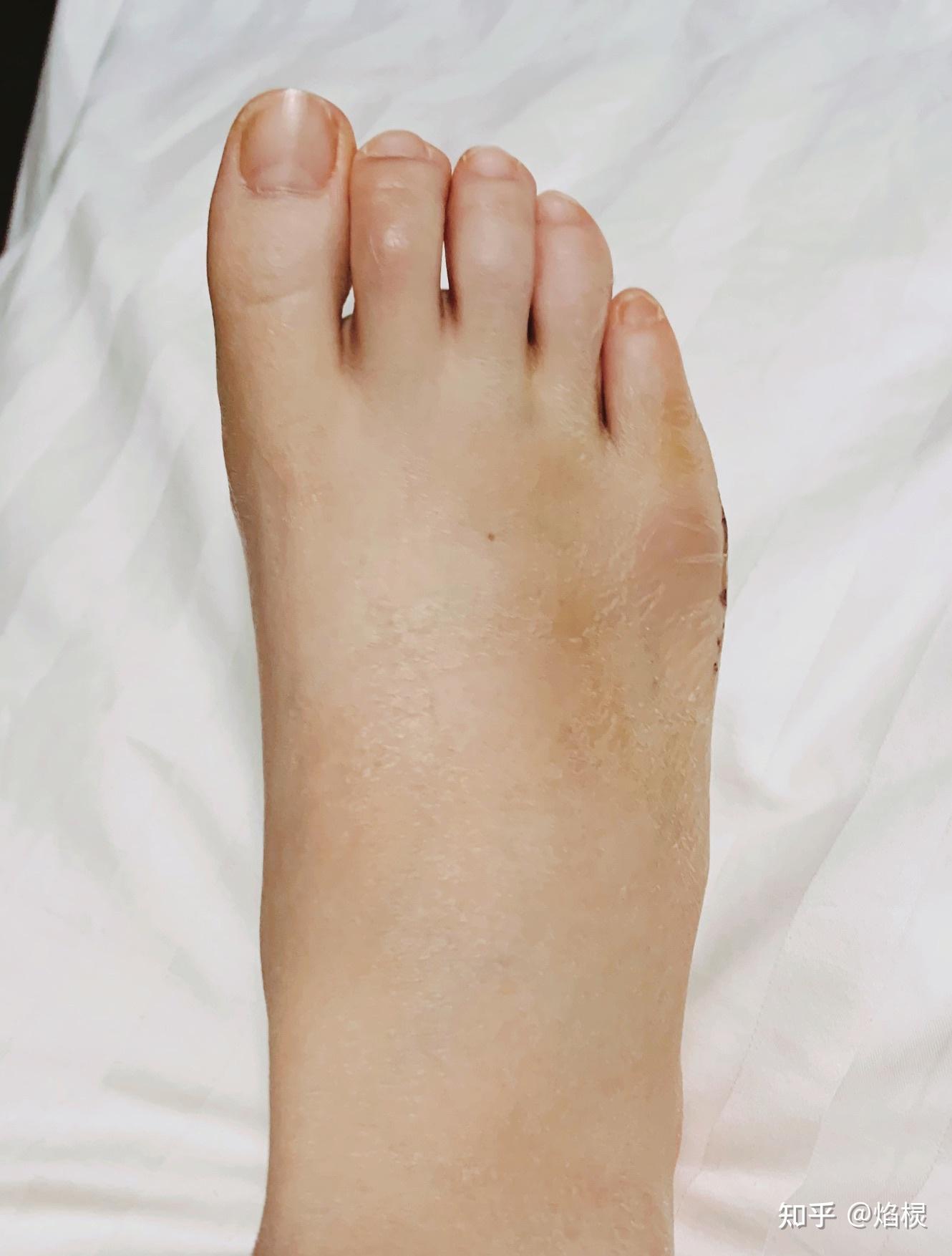 小趾内翻手术记录