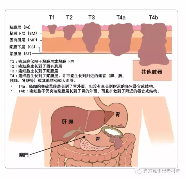 2019胃癌tnm分期图片