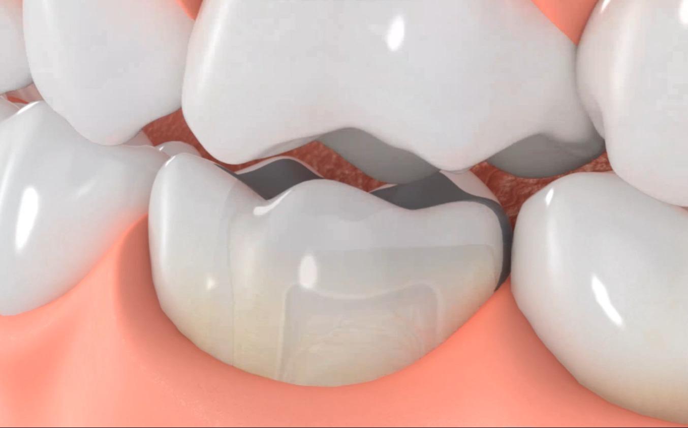 不良修复体—牙折裂 - 知乎