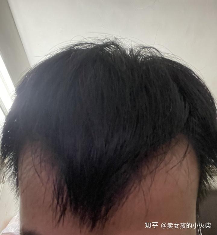 
植发后遗症放心雍禾植发
