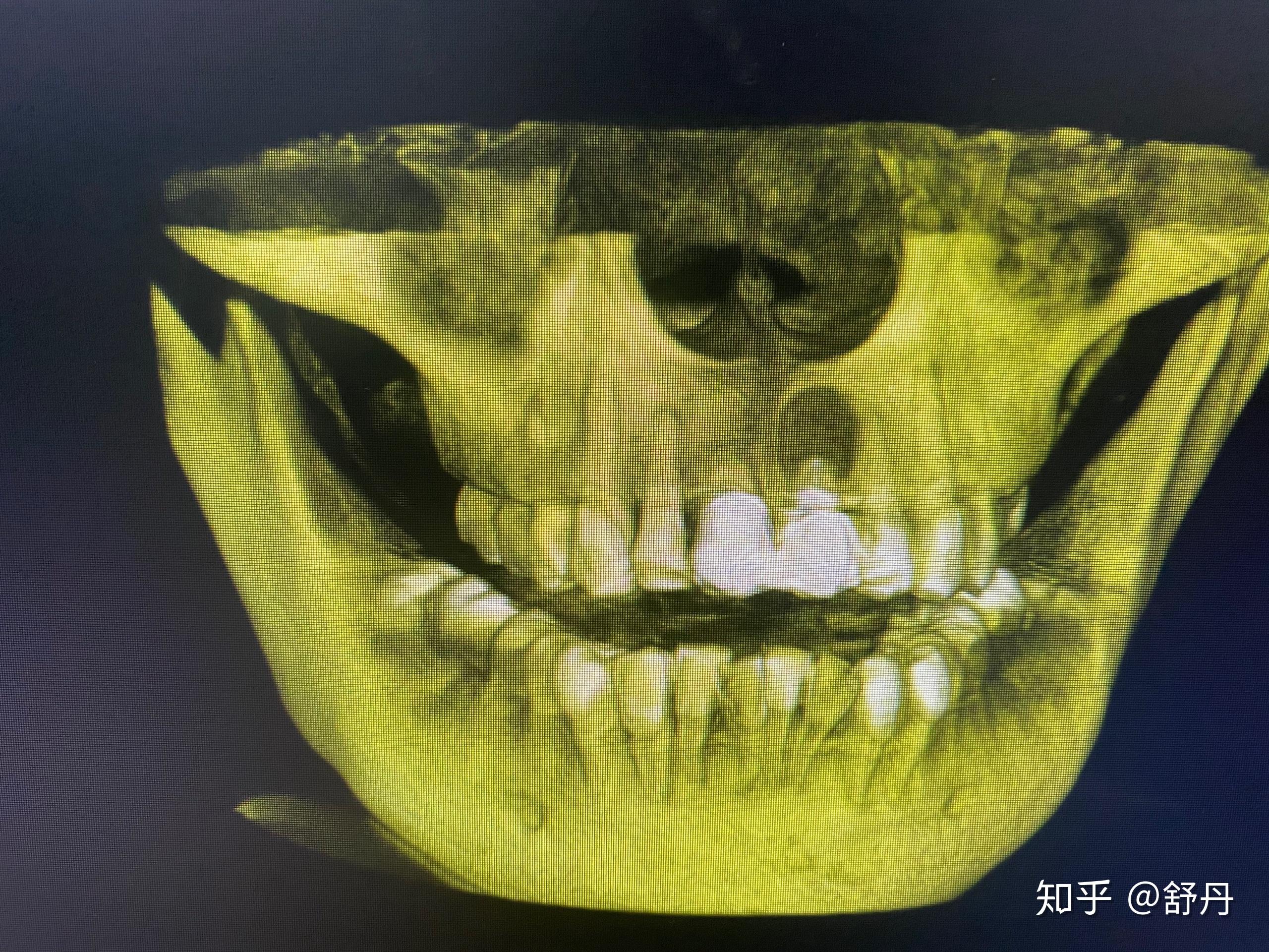 上颚骨口腔囊肿我的门牙改怎么处置啊求意见