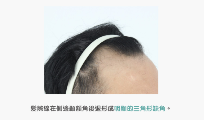不同时期的雄秃怎么分辨？有哪些专业科学的治疗方法？ - 知乎