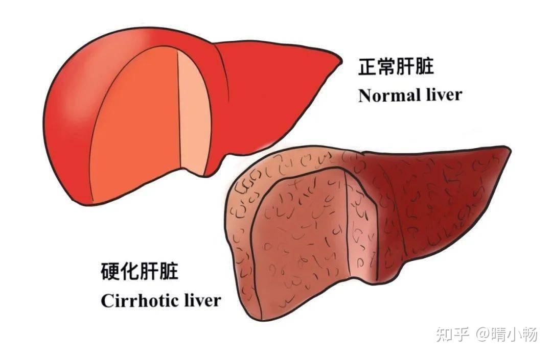 肝硬化，肝是真的硬了吗？ - 知乎
