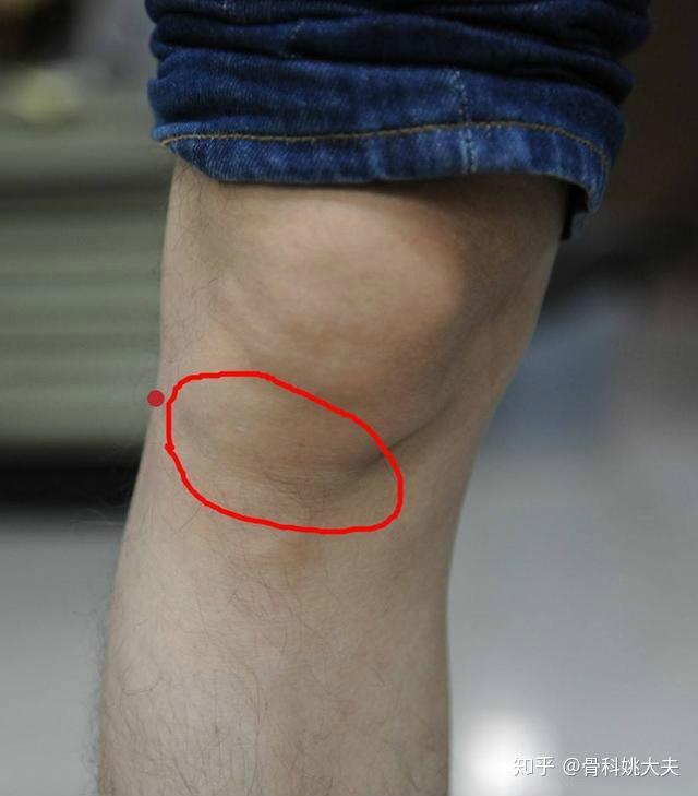 什么是滑膜炎 v2-7260ded12f9c4bd998a06d3493f5e56d_r.jpg