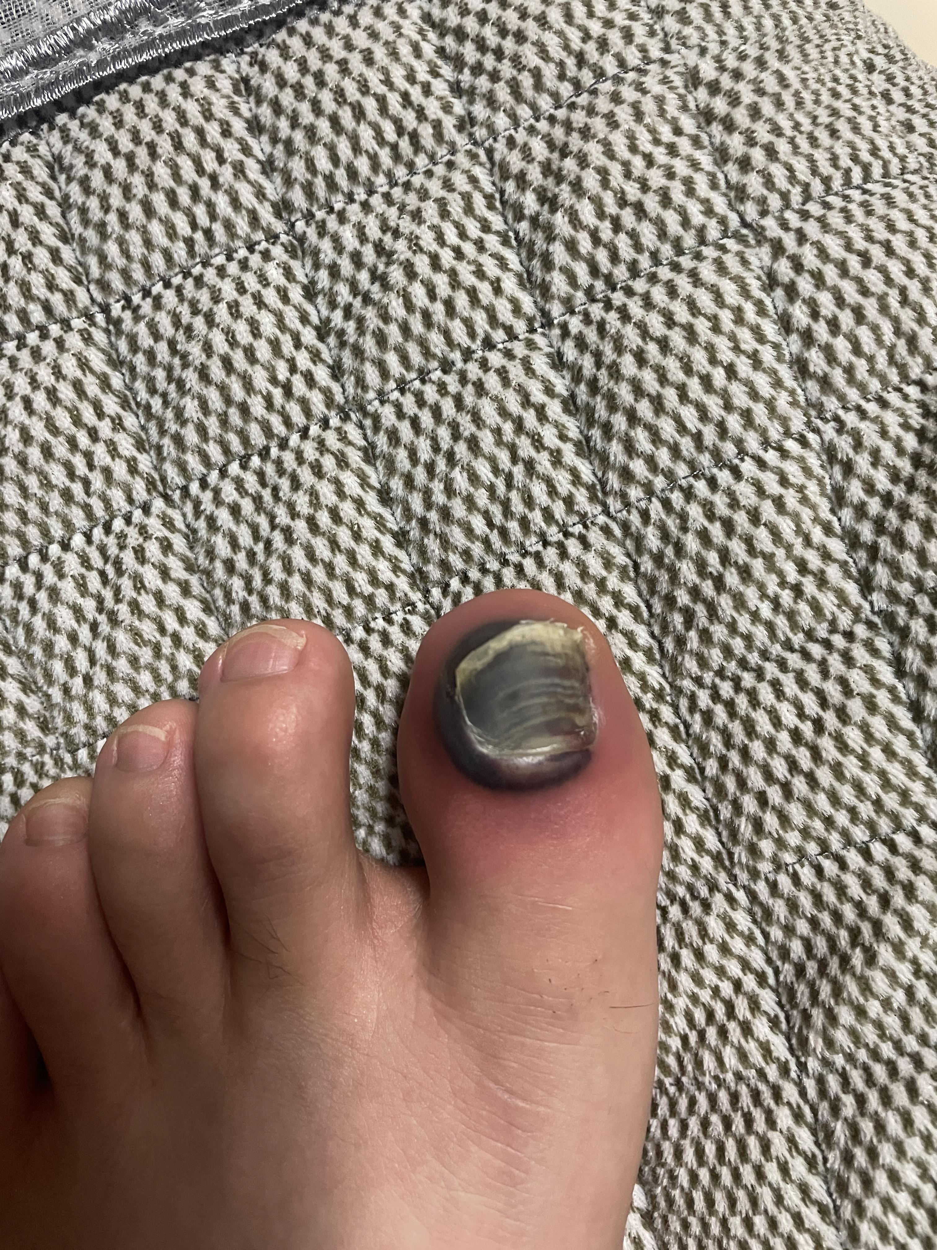 踢球脚趾甲被踩到或挤压到,最终导致淤血怎么办