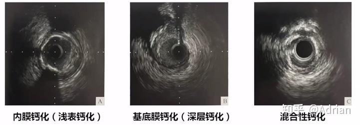 冠脉影像学CT、造影CAG、血管内超声IVUS、光学相干断层成像术OCT的比较 - 知乎