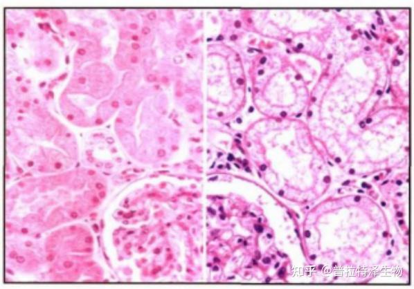 【精品技术】肾脏病理解析 - 知乎