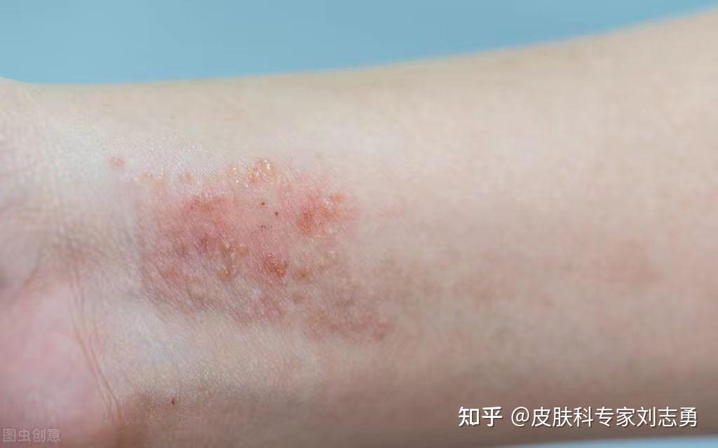 最全8大皮肤病对策、以及治疗宝典!对症用药,再也不花冤枉钱 - 知乎