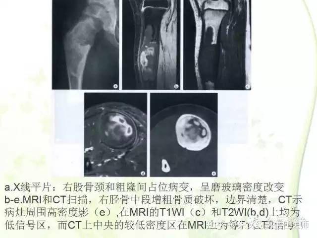 骨纤维异常增殖症的影像表现