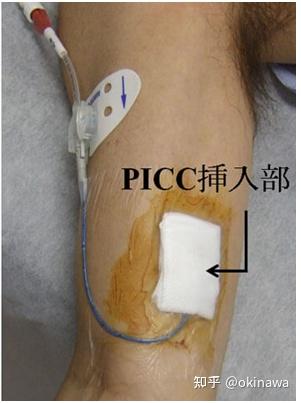 PICC(末梢留置型中央静脉导管)的管理技巧 - 知乎