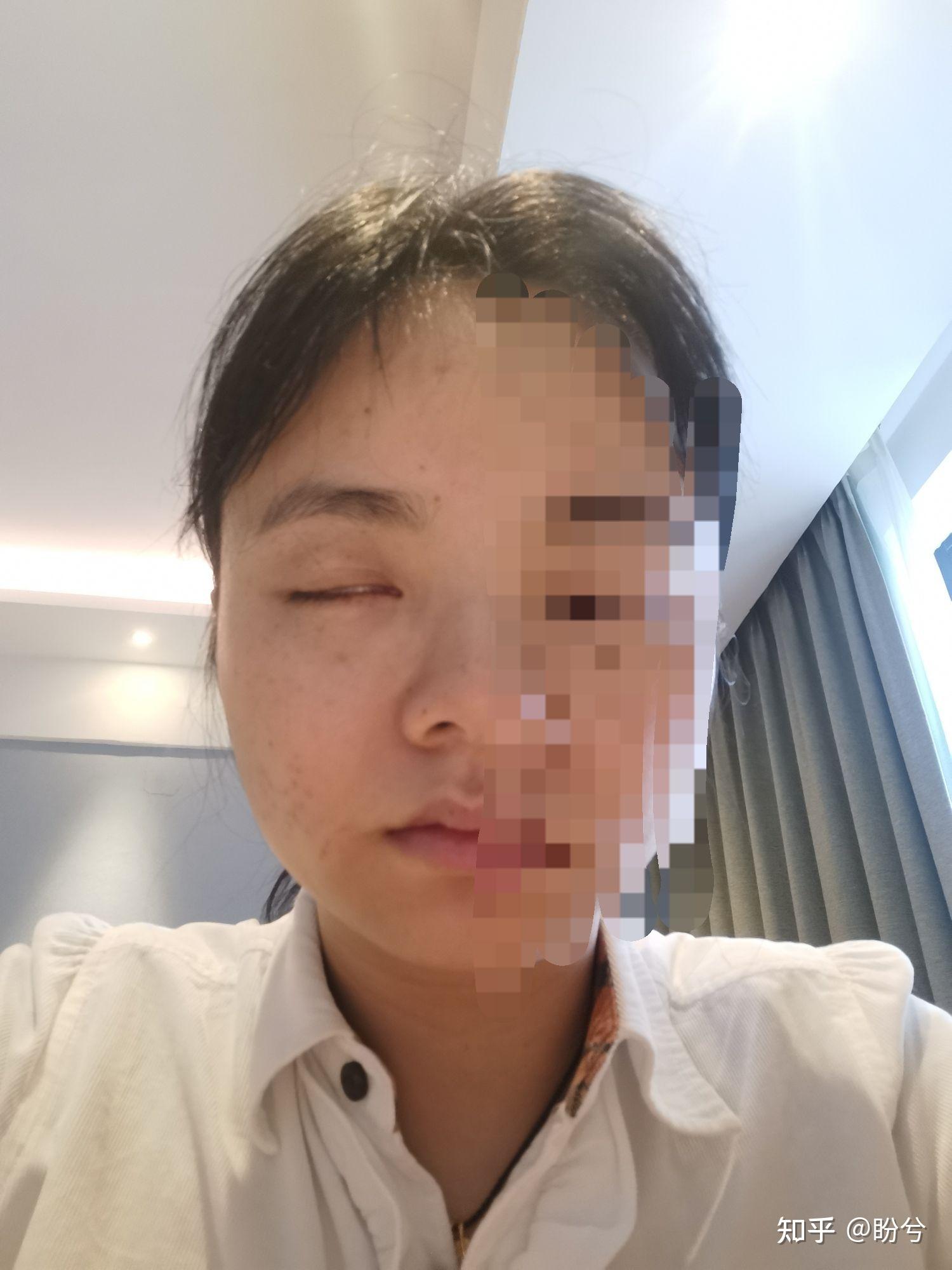 贝尔面瘫治疗记录贴