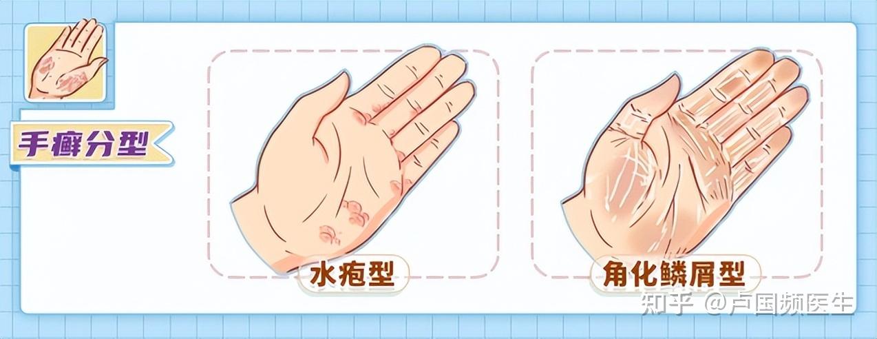 手上长小水泡,是手癣、湿疹还是汗疱疹?注意分辨,区别对待 - 知乎