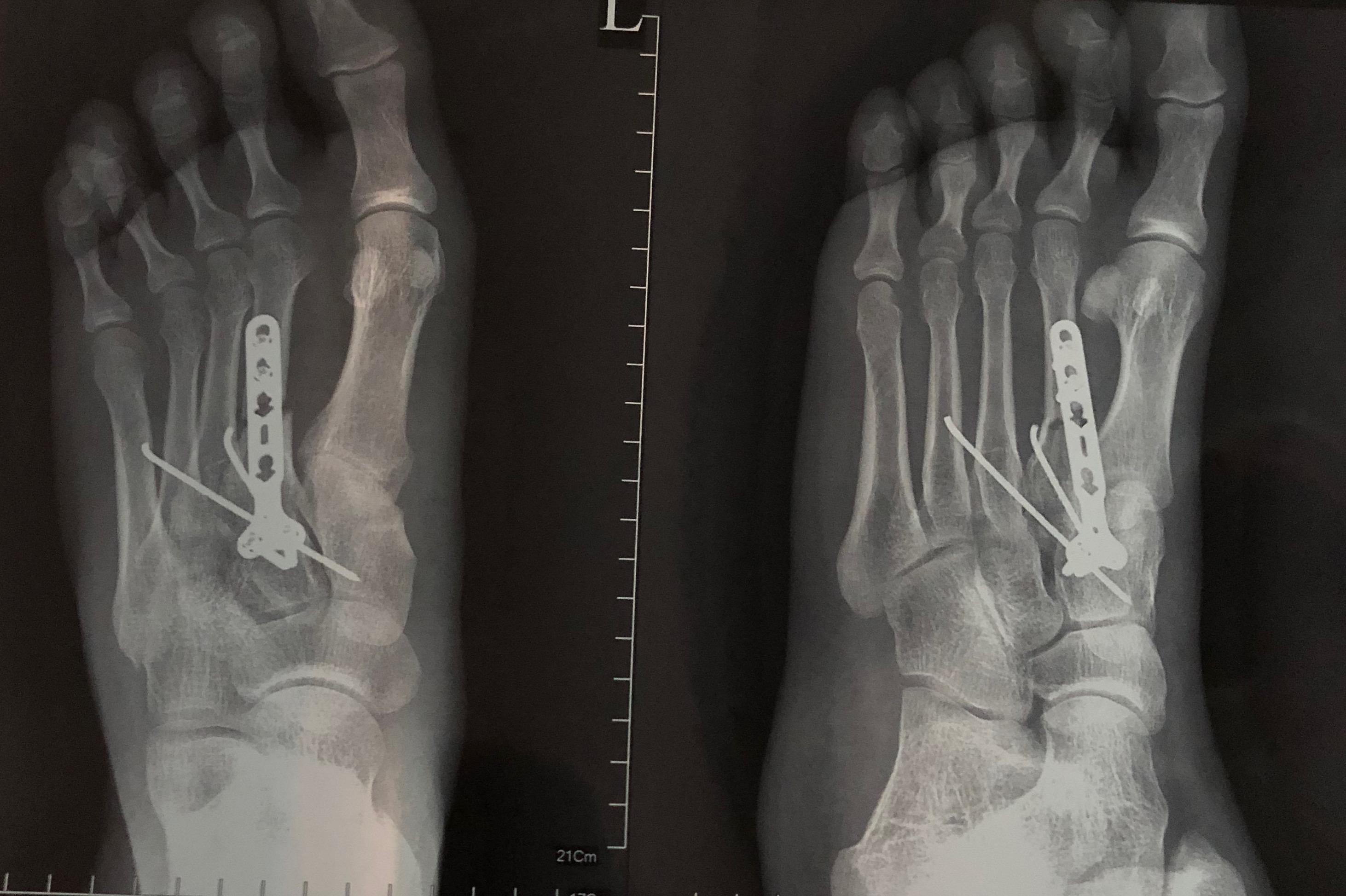 左脚第二跖骨骨折需要多久才能正常走路?